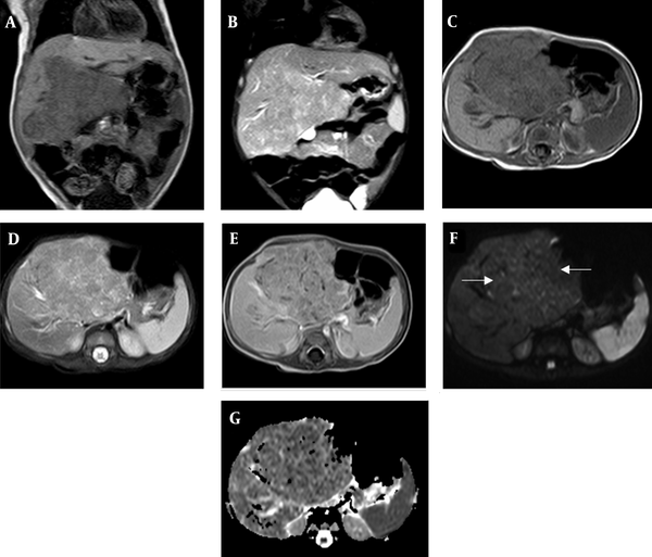 A large heterogeneous lesion with lobulated margins can be seen in the liver by contrast-enhanced MRI. A and C, Coronal and axial T1-weighted images; the tumor shows low to intermediate signal intensity; B and D, Coronal and axial T2-weighted images; the tumor shows slightly higher intermediate signal intensity; E, Post-contrast sequences show moderate enhancement; F and G, Diffusion-weighted image (DWI) and apparent diffusion coefficient (ADC) map indicate restricted diffusion (arrows).