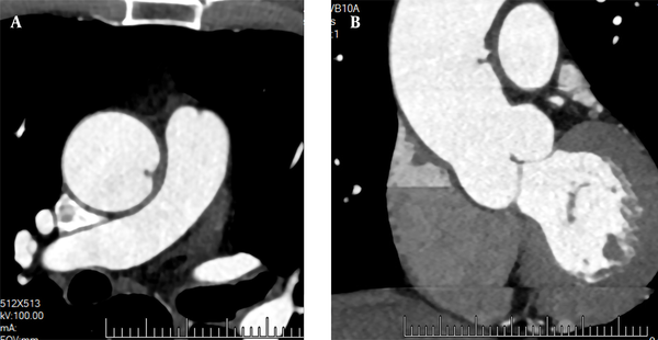 A 72-year-old male patient with recurrent chest tightness for two months. CTA cross-section (A) and multi-planar reconstruction (B) indicate a papillary filling defect in the left wall of the ascending aorta, perpendicular to the aortic wall.