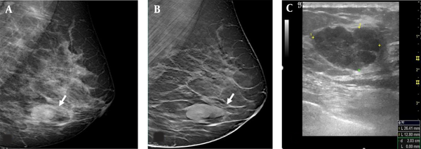 The mediolateral oblique view of digital mammography (DM) (A) reveals a nodular lesion, which is classified as breast imaging-reporting and data system (BIRADS) 0 (arrow) in the left lower breast. The mediolateral oblique view of digital breast tomosynthesis (DMT) (B) reveals well-defined contours of the lesion. On ultrasonography (C), a well circumscribed lesion is classified as category 4a, because it is palpable, and its size increases in the follow-ups. The lesion is histopathologically confirmed as usual ductal hyperplasia.