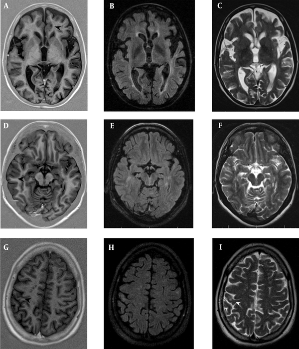 Several patients with relapsing-remitting multiple sclerosis (RRMS) showing focal lesions in the cortical grey matter. A, B & C, Intracortical (IC); and D, E & F, Leukocortical (LC) plaques were counted on PSIR (A,D) (black head arrows), but were not identified on FLAIR (B,E) and T2TSE (C,F). G, H & I, The juxtacortical (JC) lesions were observed better on, T2TSE (I) (white head-arrow) and FLAIR (H) than PSIR (G) (black head-arrow). PSIR, phase-sensitive inversion recovery; FLAIR, fluid-attenuated inversion recovery; TSE, turbo spin echo.