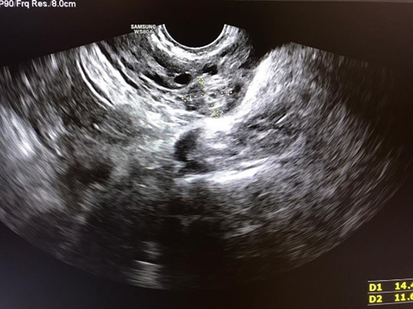 Ultrasound findings showing a 14 × 11 mm isoechoic ringlike lesion in the left adnexa, compatible with ectopic pregnancy