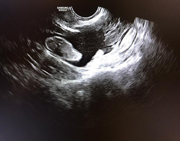 Ultrasound results showing free fluid with internal echo in the pelvic cavity, compatible with hemoperitonea