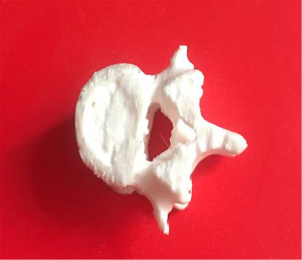 3D printed polymeric implant