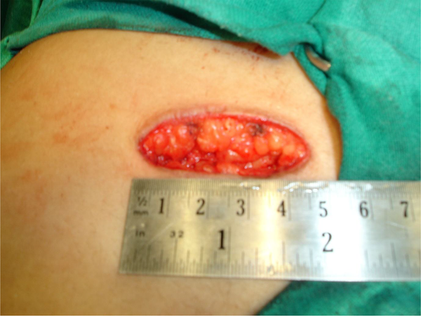 Right subcostal incision (4.5 cm) for minilaparotomy cholecystectomy Right subcostal incision (4.5 cm) for minilaparotomy cholecystectomy