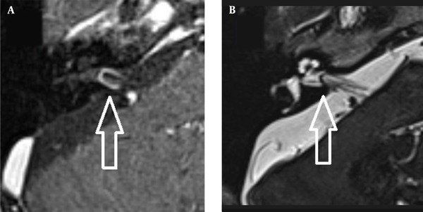 A, An anterior inferior cerebellar artery (AICA) loop on a contrast-enhanced T1W image; and B, The same loop on a T2W image (arrow).