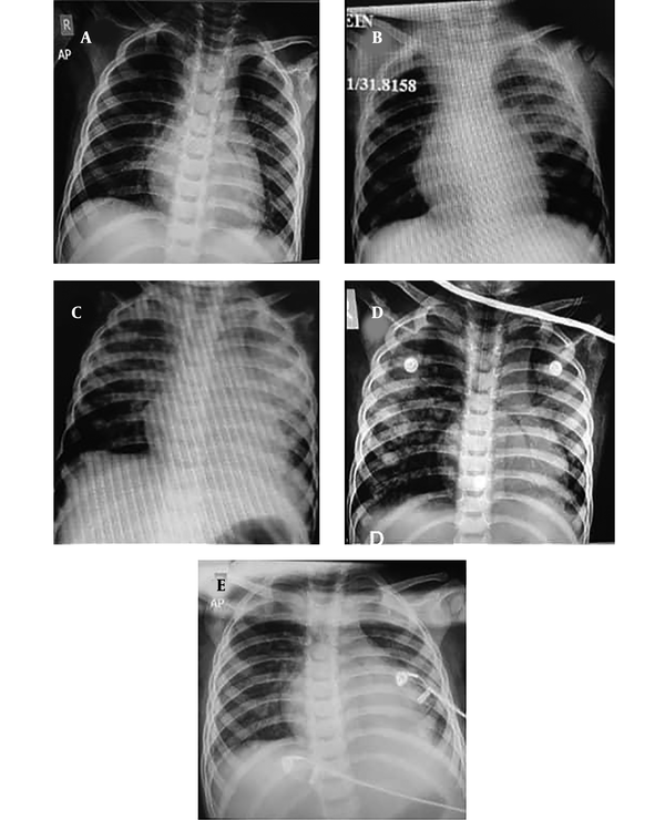 Chest radiographic manifestations: Serial chest radiographs of an 18-month-old boy with coronavirus disease 19 (COVID-19)-induced secondary hemophagocytic lymphohistiocytosis (sHLH). Images on the A, first; B, third; C, fourth; D, sixth; and E, tenth days of hospitalization, showing rapid diminishing of infiltration.