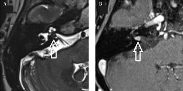 A, Axial T2W; and B, Axial contrast-enhanced T1W images of a 71-year-old female patient, indicating a schwannoma (arrows) located in the internal acoustic canal (IAC).