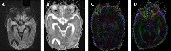 A female very-low-birth-weight (VLBW) newborn with brain injury in premature infants (BIPI) born at a gestational age of 29 weeks, with a birth weight of 1469 g and corrected gestational age of 38 weeks. A, The axial diffusion-weighted imaging (DWI) shows the paraventricular leukomalacia (PVL) in the right lateral paraventricular region; B, The apparent diffusion coefficient (ADC) value shows the main hyperintense signal in the PVL; C, The fractional anisotropy (FA) map shows that the white matter fiber bundles in the right lateral ventricle are fewer (incomplete) than those on the left side; D, A normal premature female infant born at 33 weeks of gestation, with a birth weight of 1350 g and corrected gestational age of 38 weeks. The FA map shows that the white matter fiber is normal in premature infants.