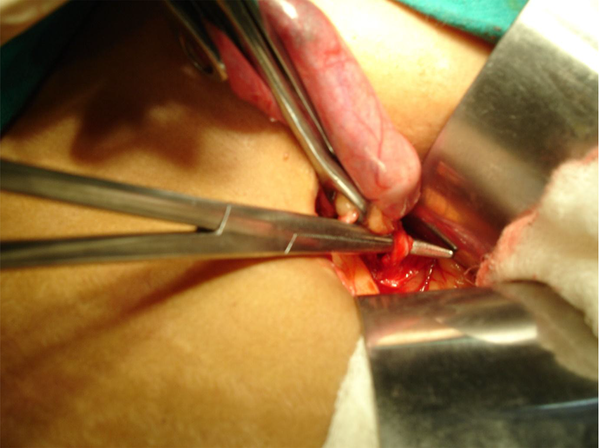 Demonstration of the cystic duct after dissection using 'fundus-first' technique with routine instruments