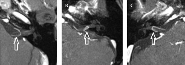 Maximum intensity projection for axial contrast-enhanced T1W images with a slice thickness of 2 mm, indicating an anterior inferior cerebellar artery (AICA) loop (arrows). A, a Chavda type 1 loop; B, a Chavda type 2 loop; and C, a Chavda type 3 loop.