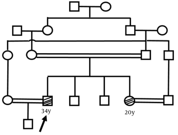 The pedigree of the referred family. The arrow shows the proband. All the black shapes show the affected individuals.
