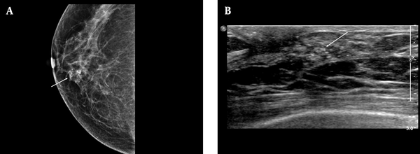A, Positive microcalcifications with high-risk histological and biological markers. The mammographic (MMG) image shows grouped, coarse heterogeneous microcalcifications in the lower inner quadrant of the right breast (arrow); B, The ultrasonography (USG) image shows echogenic microcalcifications, which can be classified as group 3 mammographic (MMG) findings. Calcification outside the mass was the most common USG finding based on the breast imaging-reporting and data system (BI-RADS) (arrow). Pathology revealed poor prognostic factors, a high nuclear grade, comedo necrosis, negative ER group, positive HER2 group, and a high Ki-67 index (≥ 20%).