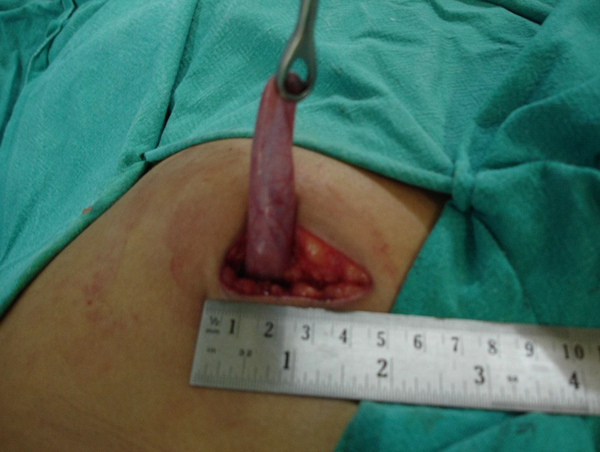 Gall bladder dissected out of a 4.5 cm right subcostal incision