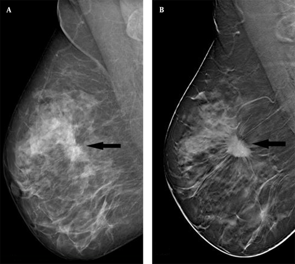 Study of role of digital breast tomosynthesis over digital