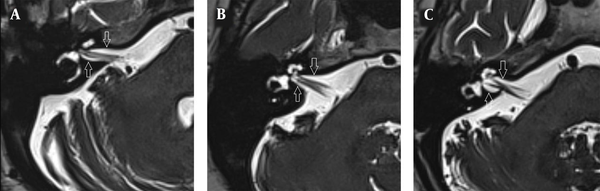 T2W images indicating the internal acoustic canal (IAC) shape (anterior and posterior borders are shown with arrows). A, Cylindrical IAC; B, Funnel-shaped IAC; and C, Bud-shaped IAC.