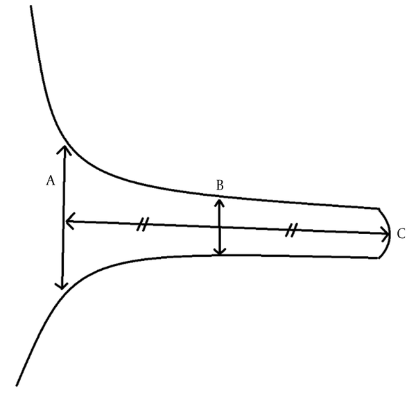 Schematic representation of the internal acoustic canal (IAC). A, Meatus width; B, Canal diameter; and C, Canal length.