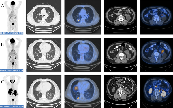 A 65-year-old man with a history of two surgeries for lung adenocarcinoma and renal cell carcinoma, presenting with a peripheral prostate lesion that was confirmed as prostate adenocarcinoma in the histopathology. The patient underwent Gallium-68-labeled prostate-specific membrane antigen (68Ga-PSMA) PET/CT scan for prostatic cancer staging. Three consecutive PET/CT scans were performed. The first 18F-fluorodeoxyglucose (18F-FDG) PET/CT scan (A) in 2015 demonstrated a hypermetabolic lesion in the right lower lobe, while no significant hypermetabolic lesion was detected in the left kidney despite an apparent simple cyst. The second 18F-FDG PET/CT scan (B) in 2018 demonstrated the recurrence of the hypermetabolic lesion in the right lower lobe, besides the emergence of a new hypermetabolic lesion adjacent to the left renal cystic lesion. The third PET/CT scan (C) with prostate-specific membrane antigen (PSMA) in 2020 demonstrated the recurrence of both right lung adenocarcinoma and left RCC lesions in the respective surgical beds.