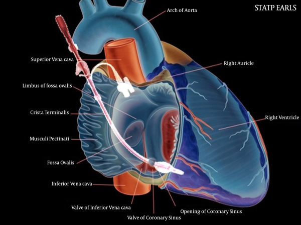 Anatomical location of coronary sinus for blood sampling
