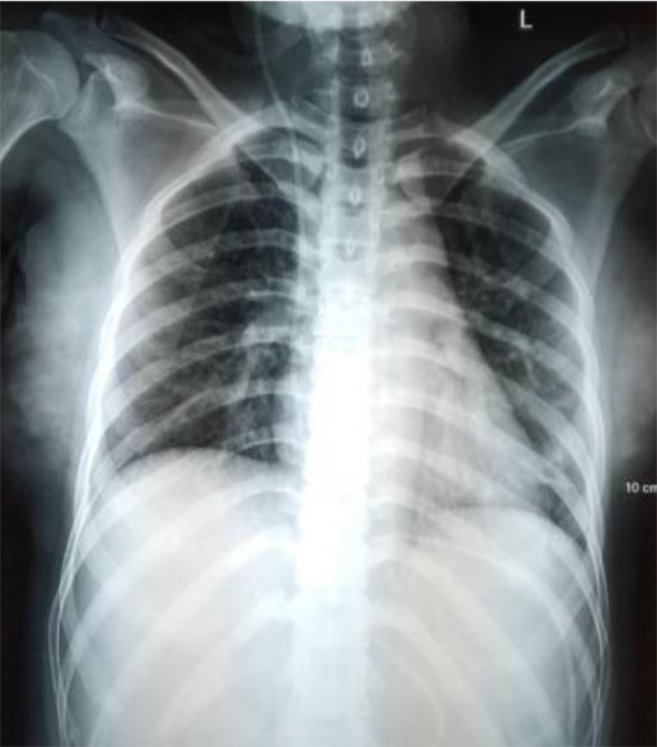 Chest X-ray AP projection. Pneumonia and minimal left pleural effusion are seen.