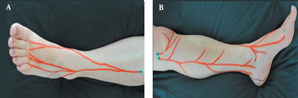 A, superficial peroneal; and B, saphenous nerve branches demonstrating chronic constriction injury sites explained by Waldman (18).
