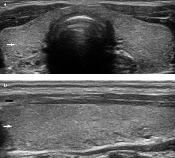 association-between-thyroid-parenchymal-echogenicity-and-thyroid