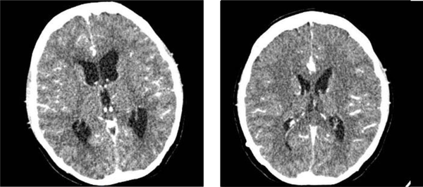 Head CT of patients with and without contrast in August 2020 (right) and September 2020 (left). Appropriate with tuberculous meningoencephalitis with increased leptomeningeal enhancement. Subacute infarction of the left temporal lobe is possibly due to vasculitis. There are no visible features of hydrocephalus and VP shunt on site.