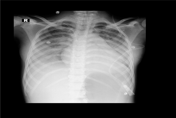 Chest X-ray of patient #1