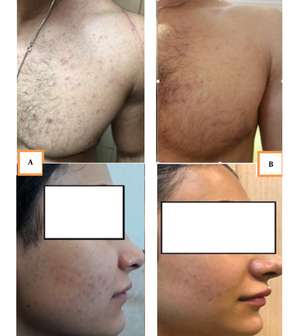 Photography of two subjects before (A) and after (B) treatment by the herbal cream