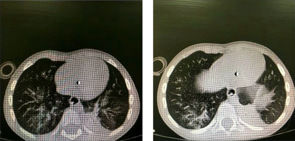 Axial Computed Tomography Images Showing Lung Involvement