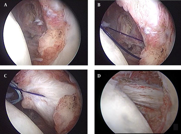 Type 4 subscapularis tendon tear retracted beyond glenoid rim (A), Nylon suture passed from retracted subscapularis tendon (B), pulling nylon suture during the release of the retracted subscapularis tendon (C), complete repair of the subscapularis tendon (D).