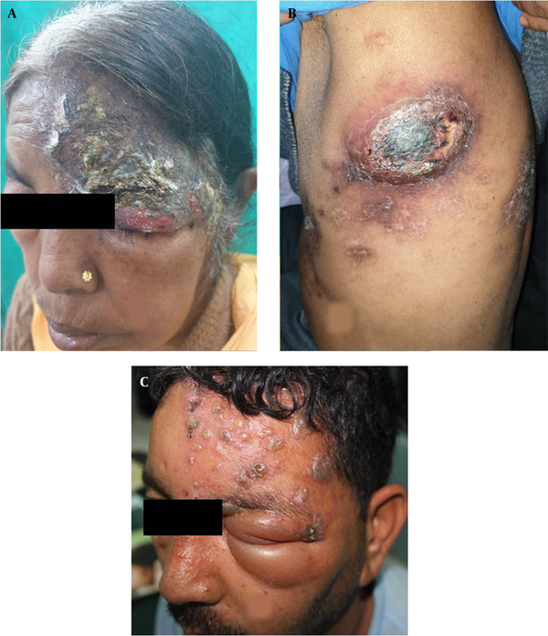 Clinical images illustrating different complications of herpes zoster; A, Illustrating severe necrosis of skin following herpes zoster ophthalmicus; B, Illustrating abscess and scarring following herpes zoster of T6 dermatome left side; C, Illustrating severe oedema of both eyelids of left side; This patient had corneal ulceration which is not observed in the image.