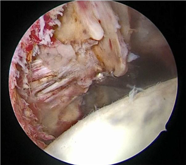 Detachment of both tendinous and muscular insertion of SSC from the humerus (type 4 tear)