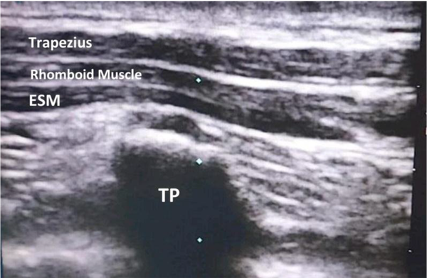 Muscles overlying erector spinae muscles (abbreviations: TP, transverse process; ESM, erector spinae muscle).