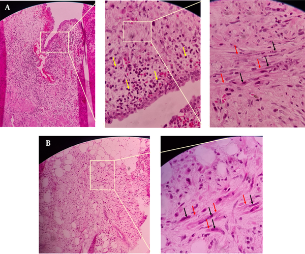 Fibrosed and inflamed ureteral tissue (A). Fibrosed retroperitoneal fat tissue (B). black arrows show activated fibroblasts that are making collagen (red arrows). Also, yellow arrows show lymphocytes at inflamed lamina propria of the ureter. Staining H & E.