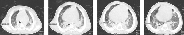 Chest CT scan of Case No. 2 showing multifocal diffused ground-glass and linear opacities in both lungs; collapsed consolidation and air-bronchogram are visible.