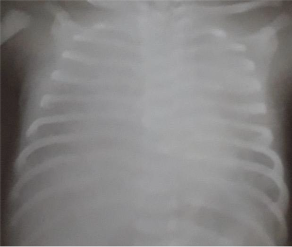 Chest X-ray of patient No. 8 with a bilateral ground-glass appearance