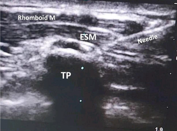 A needle penetrates the muscles until hitting the transverse process (abbreviations: TP, transverse process; ESM, erector spinae muscle).