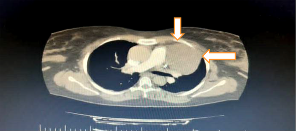 Computed tomographic scan shows anterior mediastinal mass; measures 64 × 84 cm (white arrows).