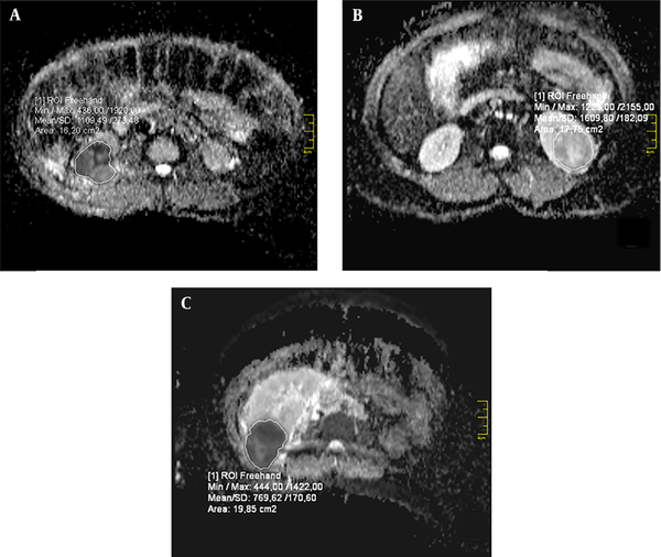 Magnetic resonance images of different renal tumors and placement of the region of interest (ROI). A, Clear cell renal cancer (ccRCC); B, Oncocytoma; and C, Primitive neuroectodermal tumor.