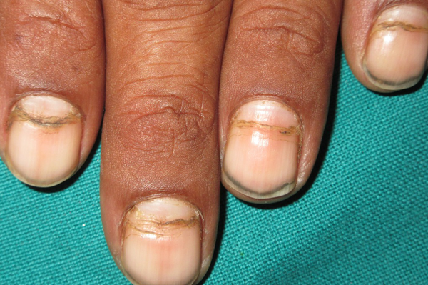 Skin Assessment - Abnormal findings: Start with visual inspection from tips  of hands (nails) > - Studocu