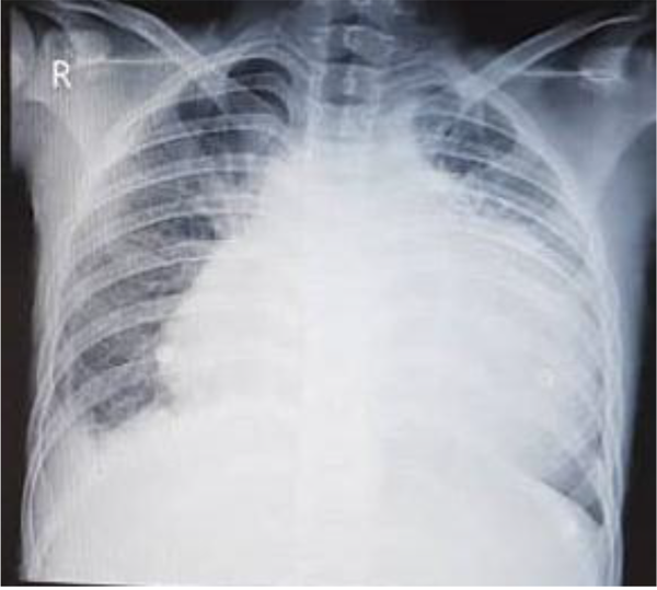 Chest X-ray of the patient with blunted costophrenic angle due to pleural effusion and enlarged heart shadow due to pericardial effusion
