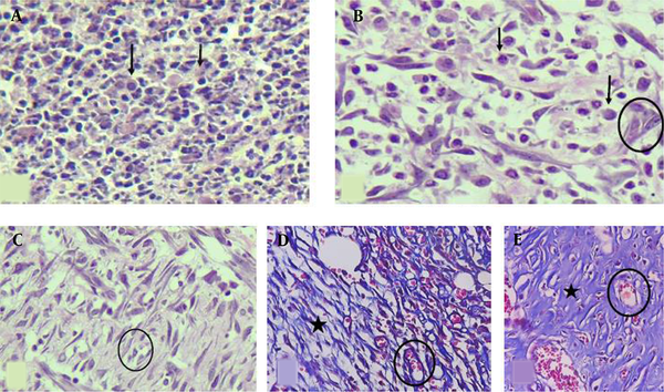 H &amp; E-stained sections showing (A) severe inflammation (score 3), no angiogenesis or fibroplasia (score 0), (B) moderate inflammation (score 2), mild angiogenesis (score 1), and edema without obvious fibroplasia, (C) moderate inflammation, moderate angiogenesis, and mild fibroplasia, (D) Masson’s trichrome stain shows mild inflammation, moderate angiogenesis, and mild fibroplasia, (E) Masson’s trichrome stain shows minimal inflammation, mild angiogenesis, and marked fibroplasia (400X). Black arrows: inflammatory cells, Circles: new vessels (angiogenesis), Star area: collagen deposition (fibroplasia).