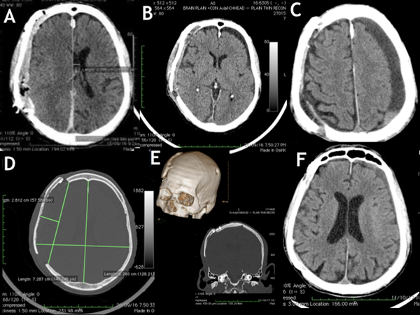 Follow-up CT scans: A, Immediate postoperative images revealed an extradural collection under the cranioplasty construct; B, Both the extradural collection and midline shift resolved in two weeks, while there was contralateral CSF hygroma; C, Contralateral chronic SDH with significant mass effect evident in 16 weeks postoperative NCCT image; D, Axial section showing an increase in the biparietal diameter of 10 mm on the cranioplasty side. The outer margin of the brain was measured to be 2.81 cm beyond the level of the craniectomy defect; E, Step ladder expansion was achieved by fixing the cranium and the bone flaps on two opposite surfaces of titanium miniplates. Volumetric 3D reconstruction also shows the contralateral burr hole; F, Eighteen months’ post-surgery, NCCT of the head showed near-complete resolution of CSF hygroma.