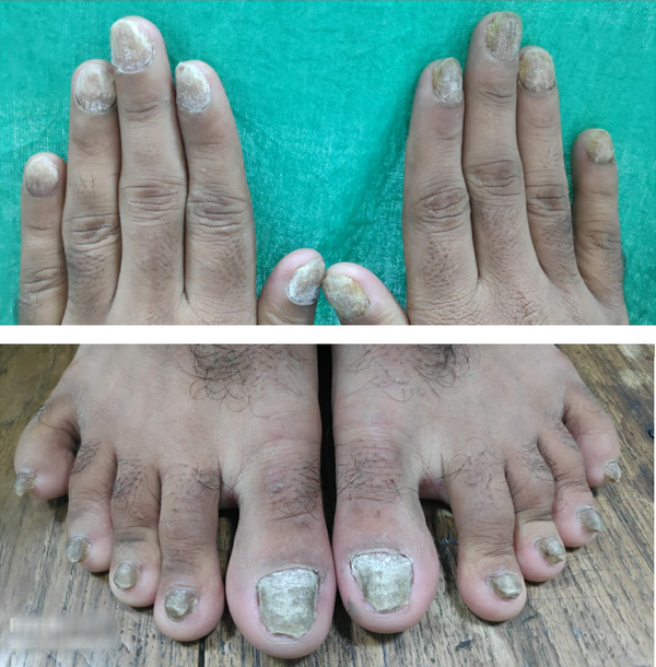 Pincer nail in a lupus patient