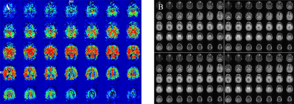 A, Inline-calculated cerebral blood flow (CBF) images show bilateral parietal hypoperfusion derived from; B, Two control and two tagged images.