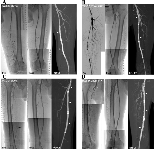 Representative cases successfully treated with paclitaxel-eluting stents (PES). Preprocedural angiography, postprocedural angiography, and follow-up CT scans acquired six months after the procedure (arrow heads) show preserved stent patency. A, A trans-Atlantic inter-society consensus document (TASC) C lesion in a 62-year-old male patient with ulcer and pain in the left big toe, treated with two Eluvia stents. B, A TASC C lesion in a 53-year-old male with 500-m claudication, treated with three Zilver PTX stents. C, A TASC D lesion in a 78-year-old male patient with 50-m claudication and total occlusion from the ostium (white arrow) to the distal superficial femoral artery (black arrow), treated with three Eluvia stents. D, A TASC D lesion in a 75-year-old male patient with 30-m claudication and total occlusion from the ostium (white arrow) to the proximal popliteal artery (black arrow), treated with three Zilver PTX stents.