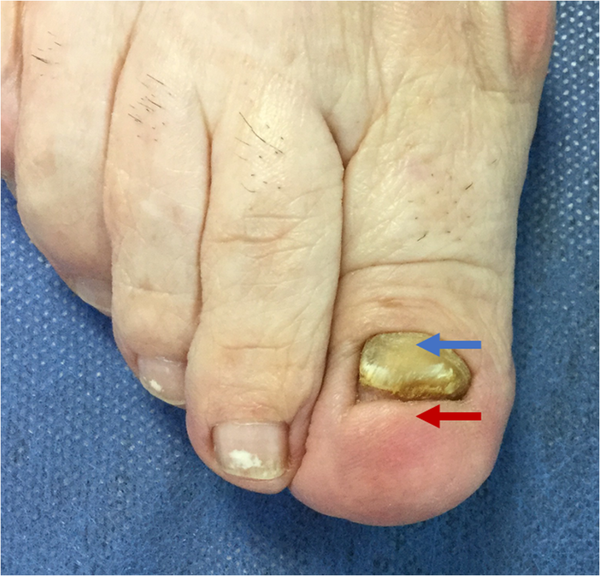 Red arrow: The distal portion of the nail bed has disappeared; it has become keratinized. Blue arrow: Thickening of the nail plate.