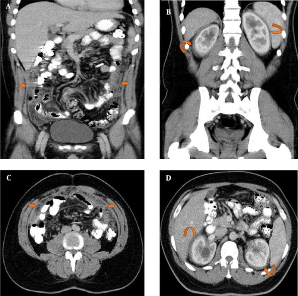 A 35-year-old man with non-specific abdominal pain, nausea, and weight loss (> 10 kg) for two years; A, C, Coronal and axial contrast-enhanced computed tomography (CECT) show an infiltrating, heterogeneously enhancing peritoneal soft tissue density, surrounding the bowel loops and significant omental caking (arrows); B, D, Coronal and axial CECT scans show that perirenal fat infiltrates symmetrically, and the perirenal fascia has a “hairy kidney” appearance (curved arrows). The renal calyceal system is also dilated on both sides.