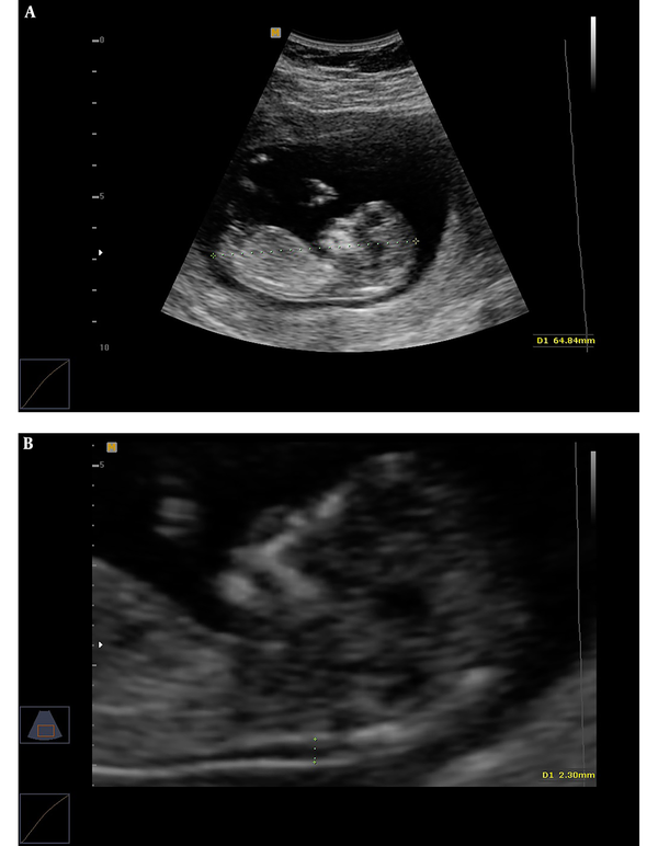 The measurement of fetal crown-rump length (CRL) (A) and nuchal translucency (NT) thickness (B) in the first trimester of pregnancy.