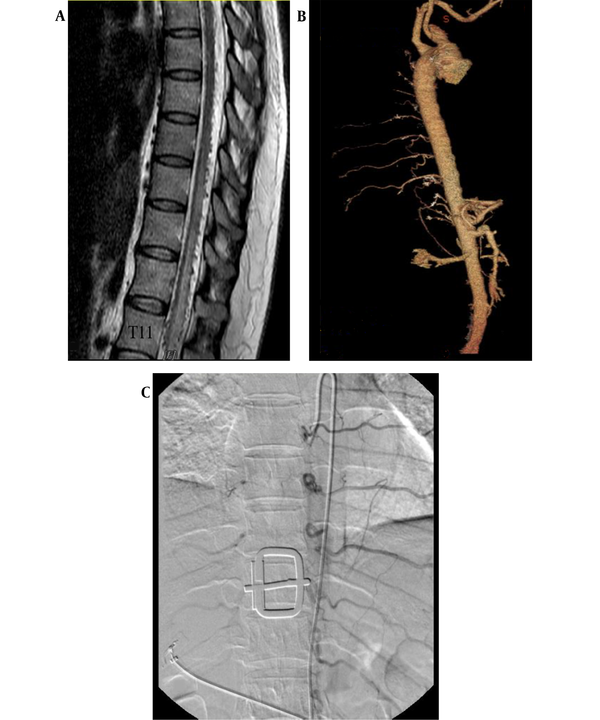 A, Sagittal T2-weighted MRI shows spinal cord edema, as well as dilated and tortuous signal voids; B, CT angiography of the thoracic aorta and spinal artery; C, Spinal angiography shows no fistula